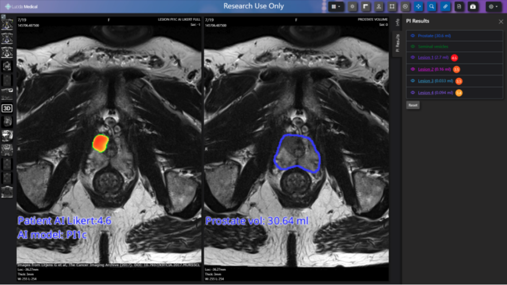 Macmillan Cancer Support, the UK’s leading cancer charity, is investing £350,100 in Lucida Medical’s pioneering new AI platform, Pi™, with the aim of improving the speed and accuracy of prostate cancer tests.
