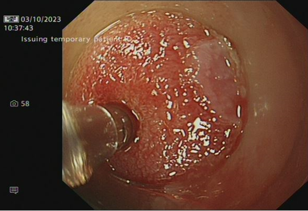 View from the endoscope of the RaPIDE Probe measuring oesophageal tissue. Credit: The RaPIDE project.