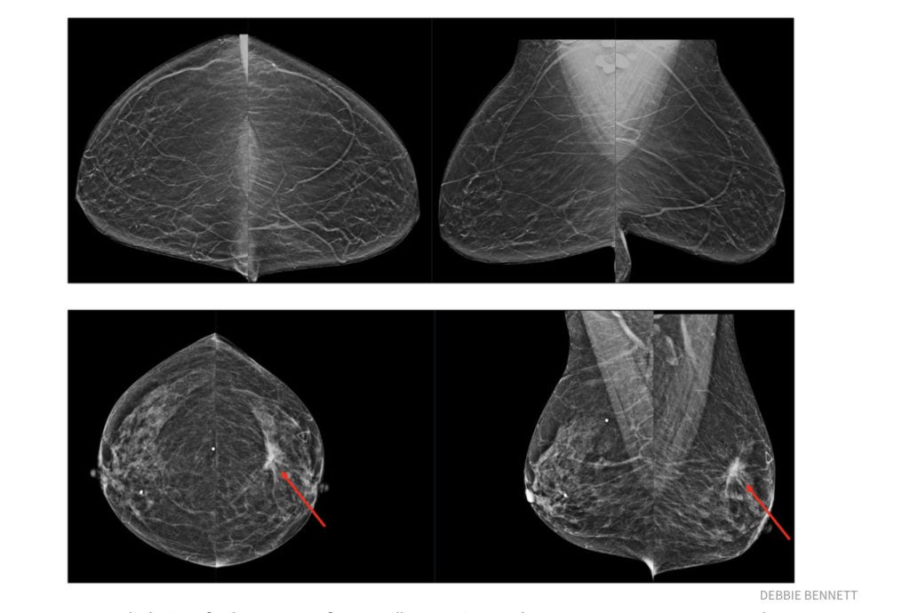 On average, radiologists find one case of cancer (bottom images) in every 200 mammograms they evaluate. The top images show no cancer. In a recent study, researchers at Washington University School of Medicine in St. Louis and Whiterabbit.ai showed that AI assistance potentially could improve breast-cancer screening by reducing the number of false positives without missing true positives.