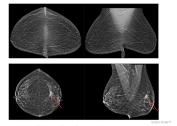 On average, radiologists find one case of cancer (bottom images) in every 200 mammograms they evaluate. The top images show no cancer. In a recent study, researchers at Washington University School of Medicine in St. Louis and Whiterabbit.ai showed that AI assistance potentially could improve breast-cancer screening by reducing the number of false positives without missing true positives.