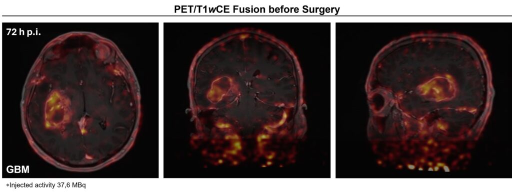 Brain PET scan after injection - before surgery