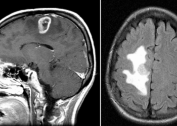 These images show a brain tumor called glioblastoma in the right frontal lobe of a 40‑year‑old patient.