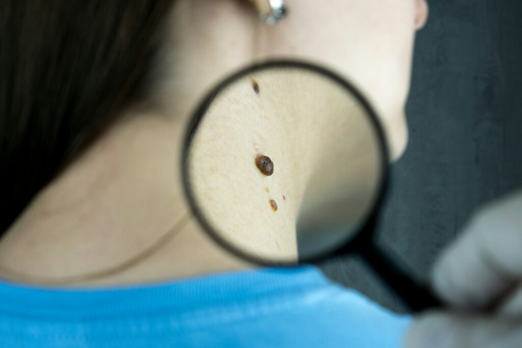 Researchers have uncovered a previously unknown mechanism that helps melanoma cells spread through the body and evade some of the most effective cancer treatments available.
