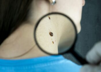 Researchers have uncovered a previously unknown mechanism that helps melanoma cells spread through the body and evade some of the most effective cancer treatments available.